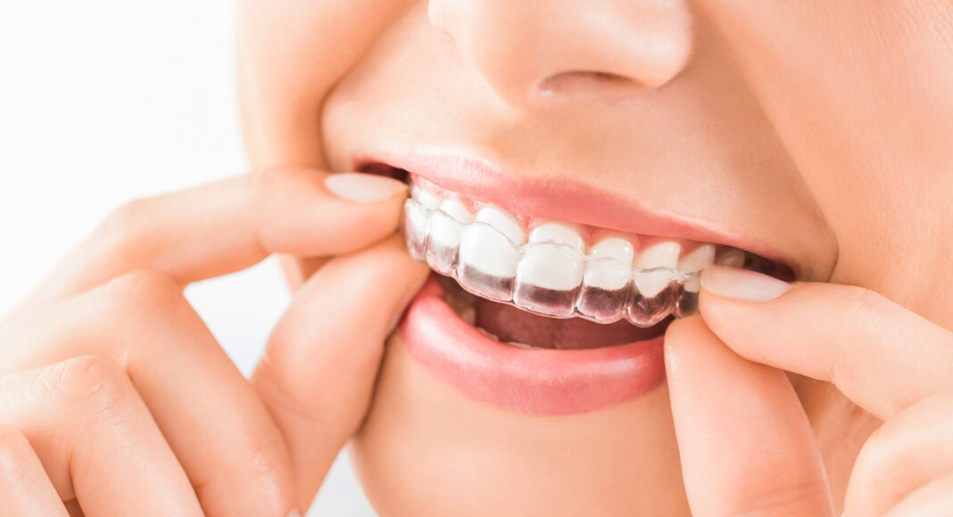 Aligner sind eine nahezu unsichtbare und komfortable Methode zur Korrektur von Zahnfehlstellungen. Foto: istock