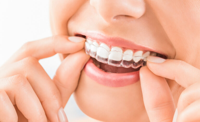 Aligner sind eine nahezu unsichtbare und komfortable Methode zur Korrektur von Zahnfehlstellungen. Foto: istock